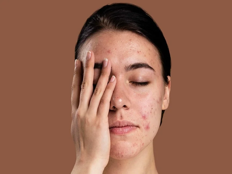 جوش صورت و آکنه چیستند و چگونه به وجود می‌آیند؟