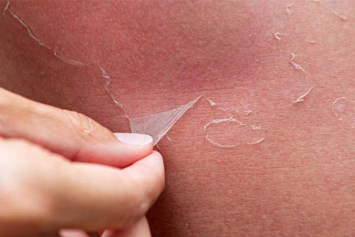 آفتابسوختگی چیست و چرا اتفاق میافتد؟