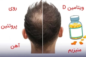 کمبود ویتامین چگونه باعث ریزش مو می‌شود؟