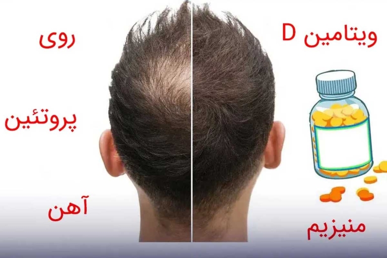 کمبود ویتامین چگونه باعث ریزش مو می‌شود؟