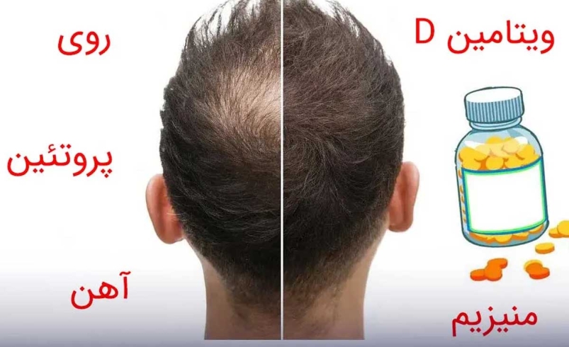 کمبود ویتامین چگونه باعث ریزش مو می‌شود؟