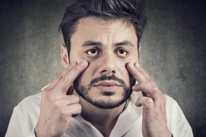چرا سفیدی چشم زرد می‌شود؟ راه‌های تشخیص و درمان سریع
